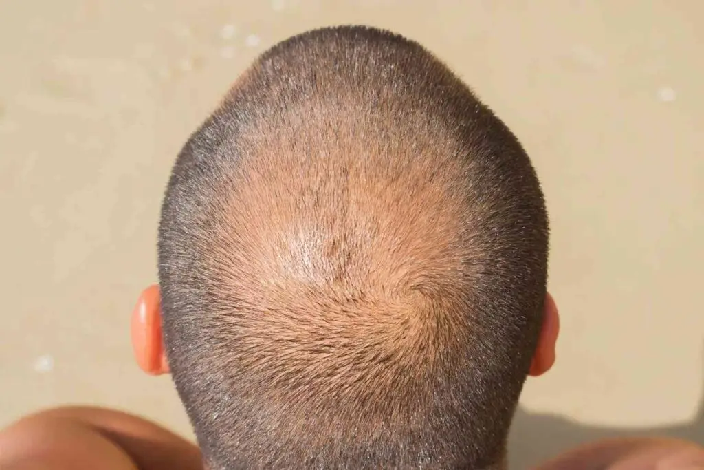 nettle root for hair loss - nettle root for hair DHT blocking